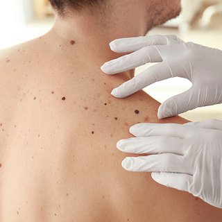 Врач назвал первые признаки смертельно опасного заболевания кожи